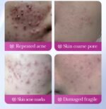 SADOER HYAKURONIC  ACNE PATCH SD17796 - Image 5