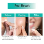 SOME BY ME acne CLEAR SPOT PATCH 18 PCS - Image 3